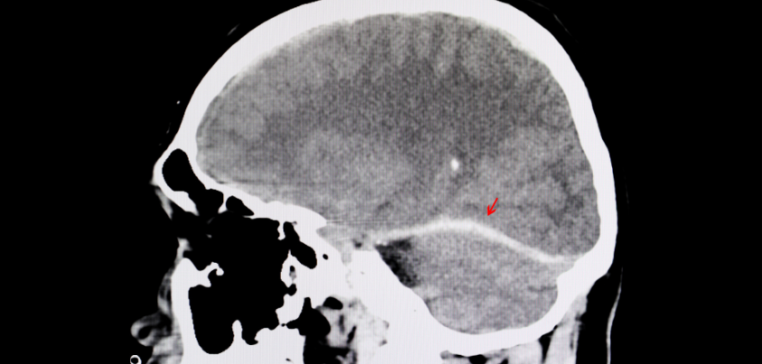 Recognizing The Signs and Symptoms of Concussion